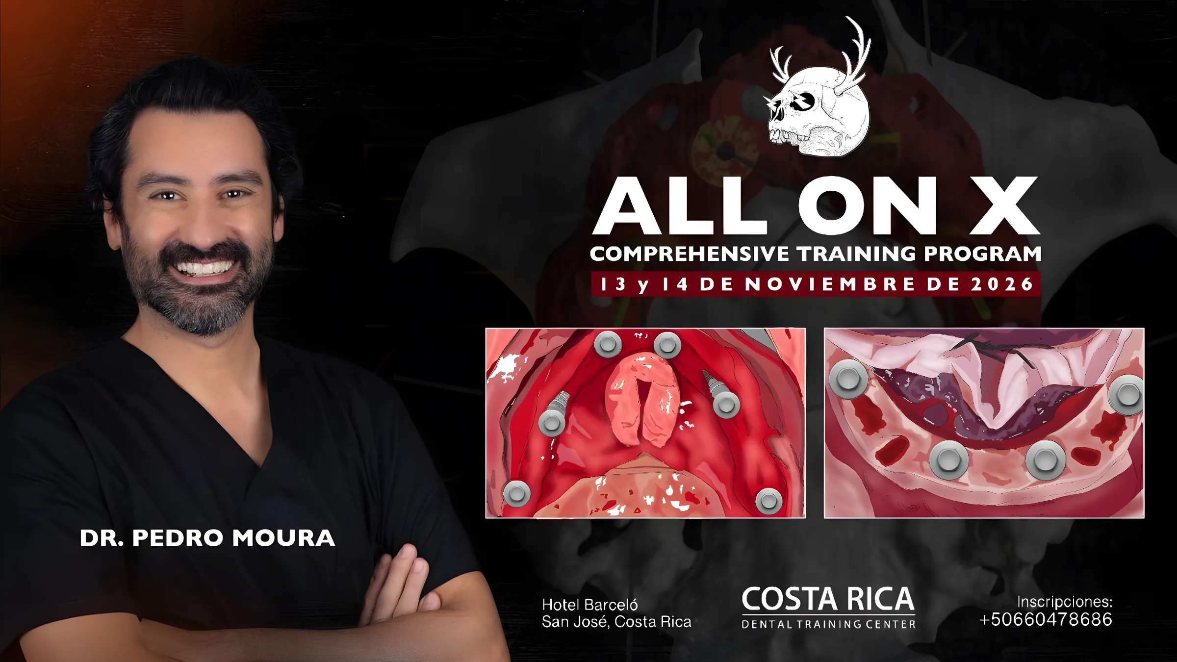 Detalle del curso ALL ON X, Programa de treinamento abrangente, con Dr. Pedro Moura — 13 e 14 de novembro de 2026
