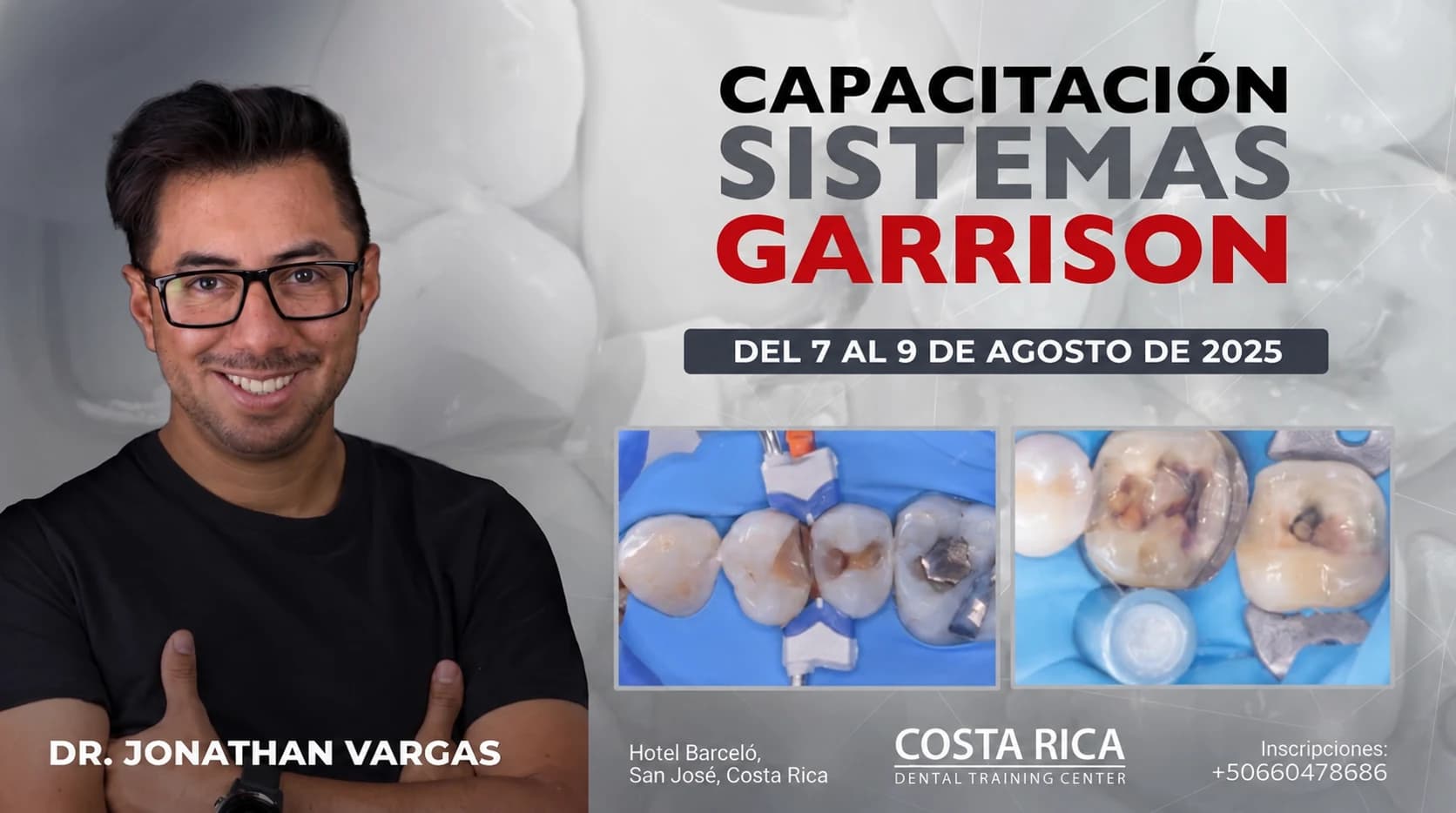 Afiche promocional del curso SISTEMAS GARRISON: Restaurações adesivas posteriores: soluções clínicas para casos de alta complexidade, dictado por Dr. Jonathan Vargas el 7, 8 e 9 de agosto de 2025 en Hotel Barceló, San José
