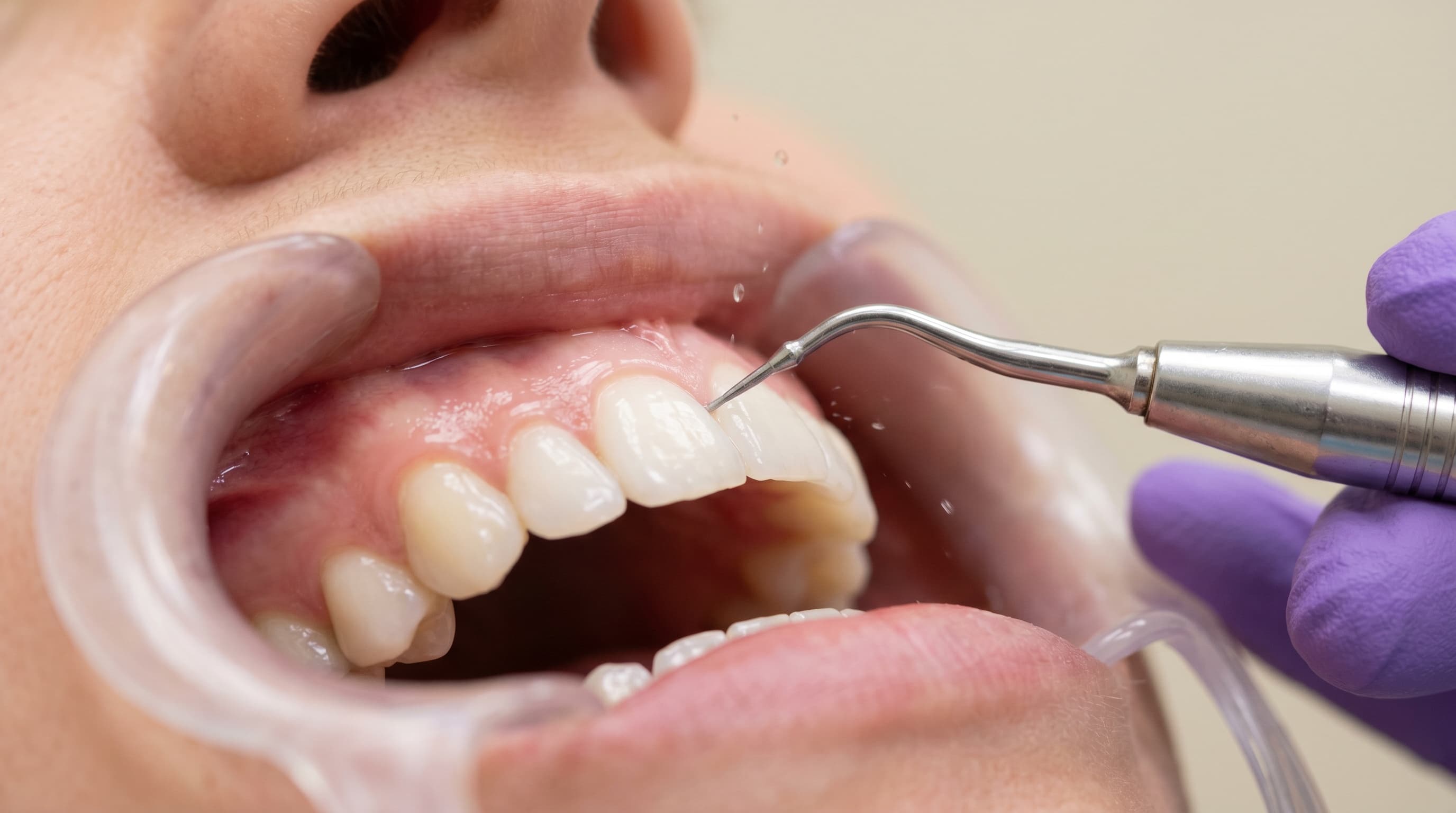 Limpeza Dentária